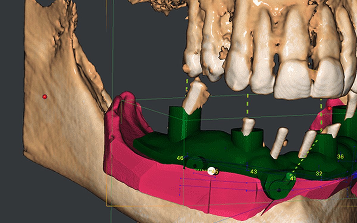 Установка 3D Dental Planning — Планирование лечения