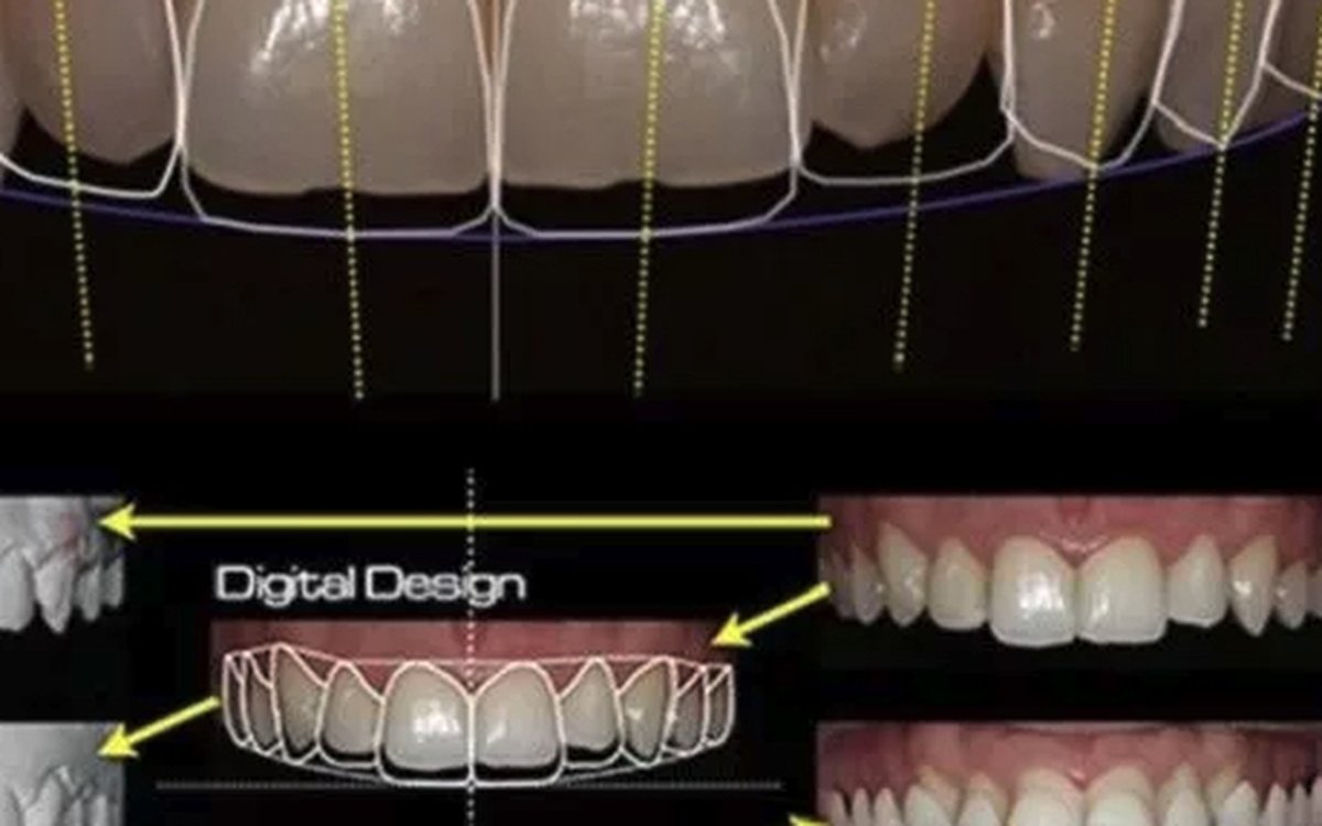 Установка DSD — Digital Smile Design — CAD/CAM системы
